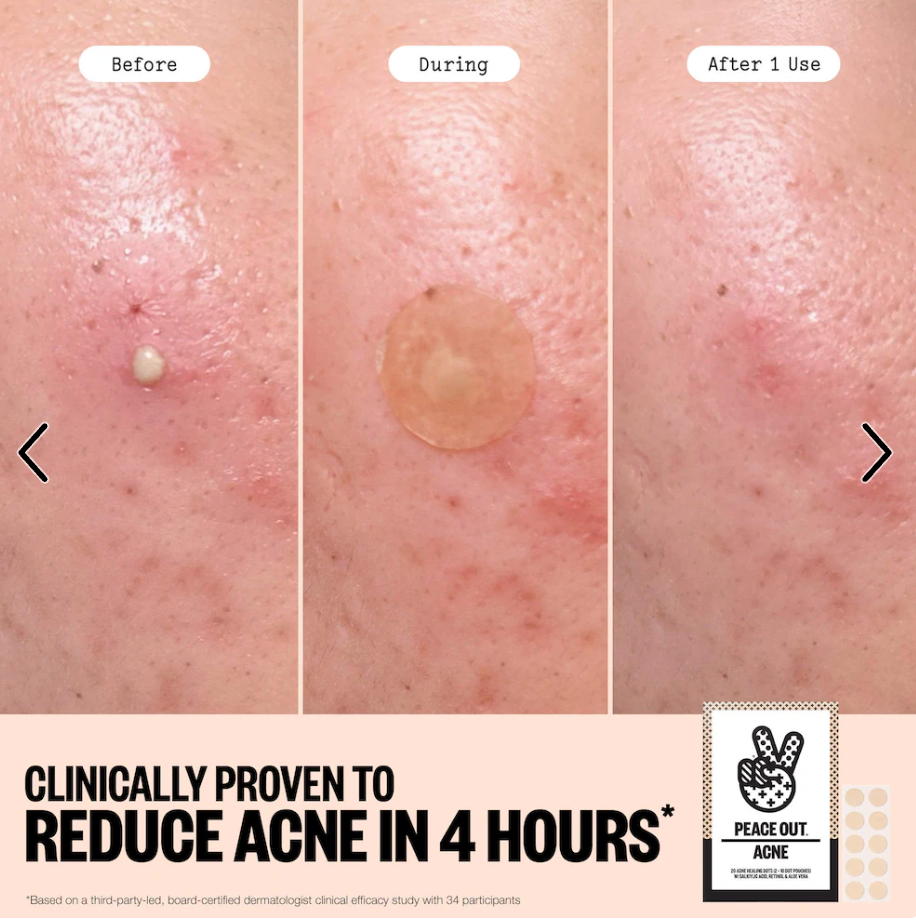 Peace Out Salicylic Acid & Hydrocolloid Acne Healing Pimple Patches - 20 DOTS