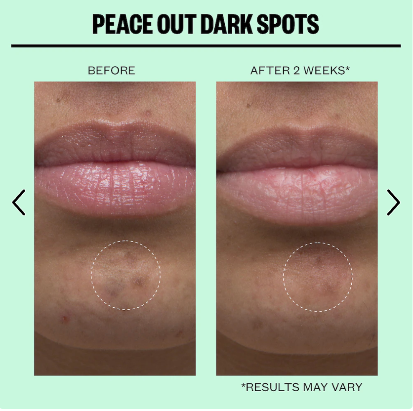 Peace Out Microneedling Dark Spot Brightening Dots